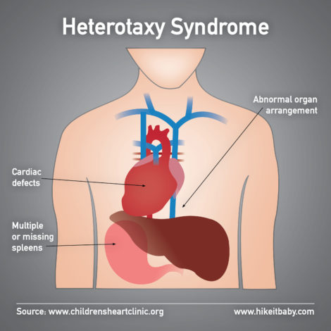 Diagram of Heterotaxy Syndrome